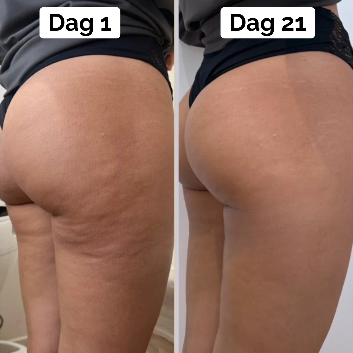 BodySculp 2.0 - Effektiv mod appelsinhud og fedtdepoter - Image 5
